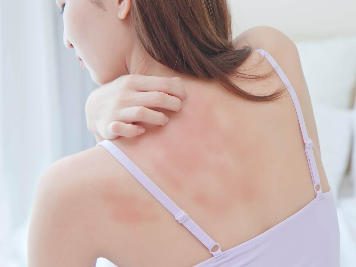 ¿Estrés y dermatitis atópica? Experta explica por qué pueden estar relacionados