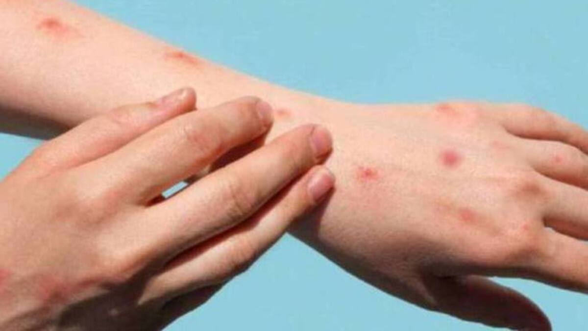 Ya van 74 casos de viruela del mono en Santander