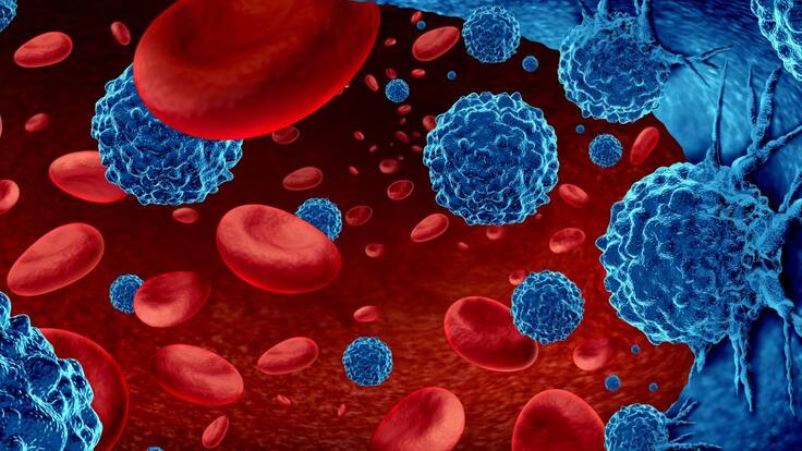 Mieloma múltiple: Qué es y cuáles son su síntomas