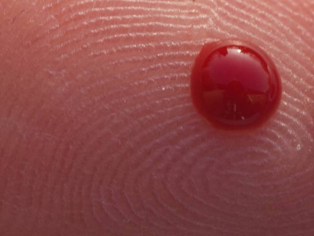 Páncreas artificial, una alternativa en el tratamiento de la diabetes