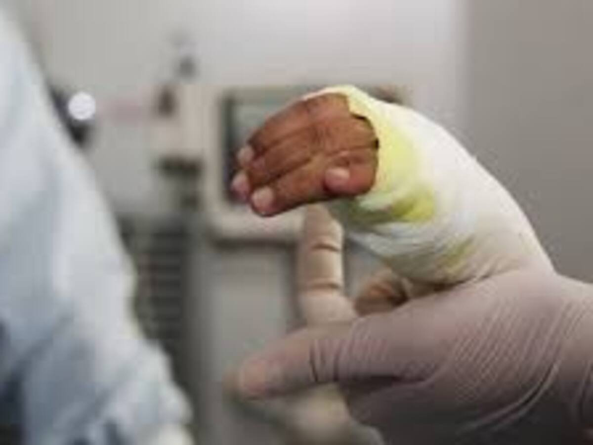 Se registra primera persona quemada con pólvora en el departamento del Huila
