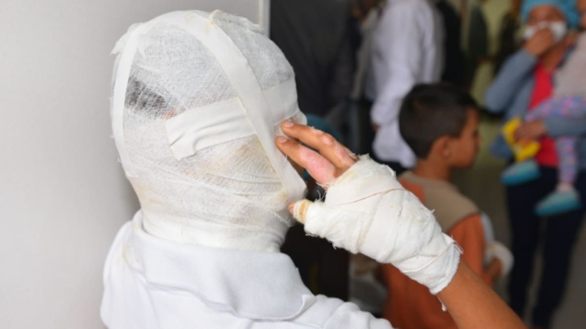 Antioquia llega a 189 lesionados por pólvora y las unidades de quemados están al 100 %