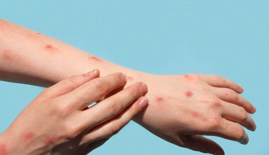 En Colombia se han registrado 12 casos de Viruela del Mono. Foto: Getty Images. 