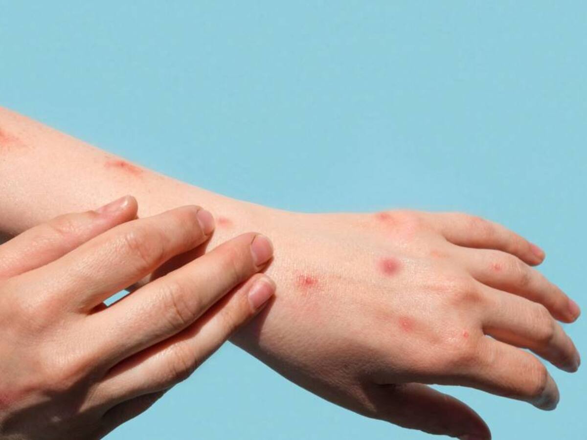 Controlar la Viruela del Mono sería más sencillo en comparación al COVID-19