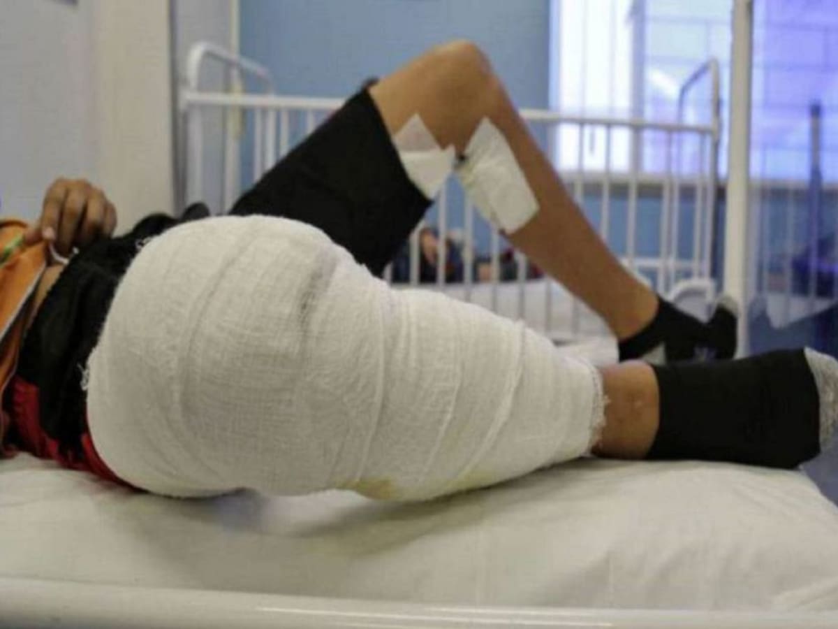 En celebración de navidad 105 personas se quemaron con pólvora en Colombia