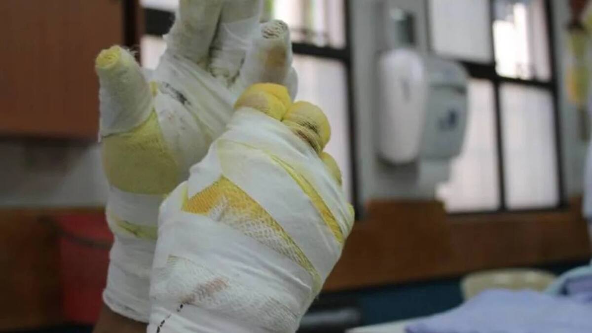 Mujer le prendió fuego a su exmarido en el barrio Nelson Mandela de Cartagena