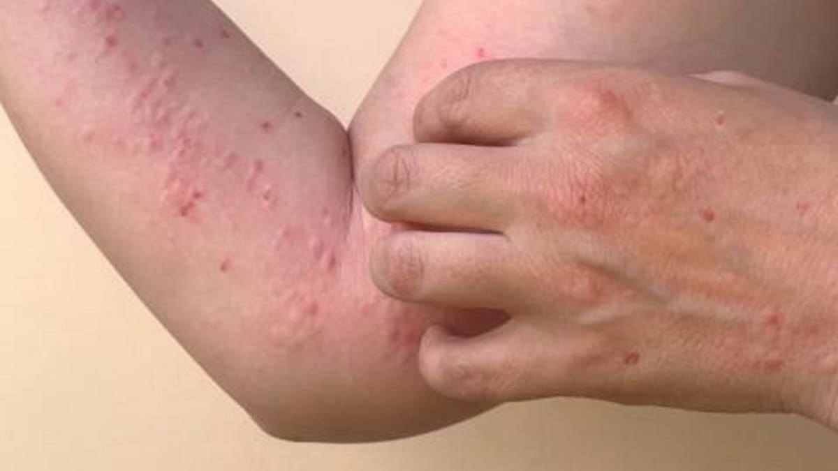 A diferencia del COVID, la viruela símica no se transmite tan fácil: médico epidemiólogo