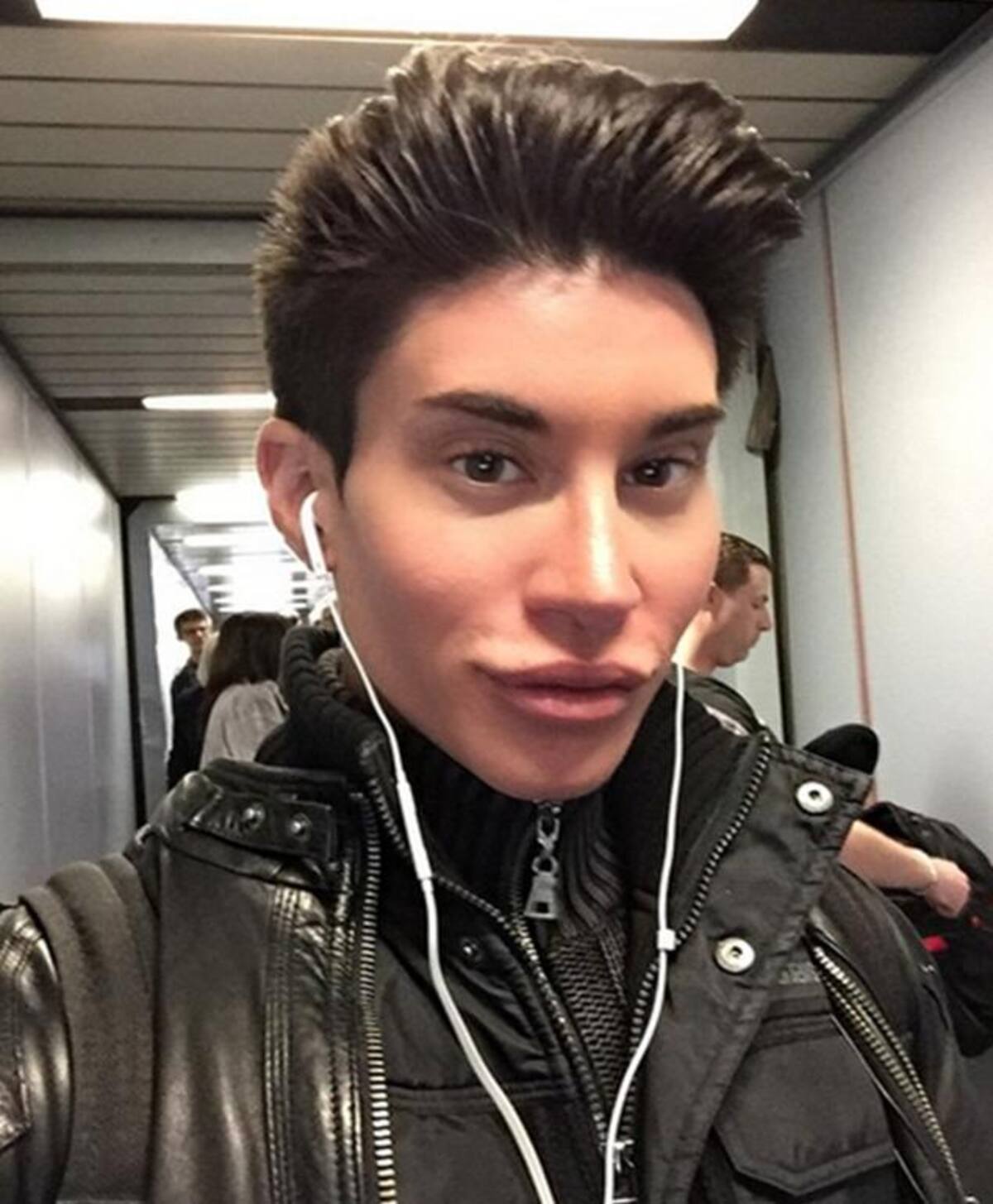Justin Jedlica se operó para remover tres venas de su frente, intervención que lo pudo dejar ciego. Fotos: Instagram.