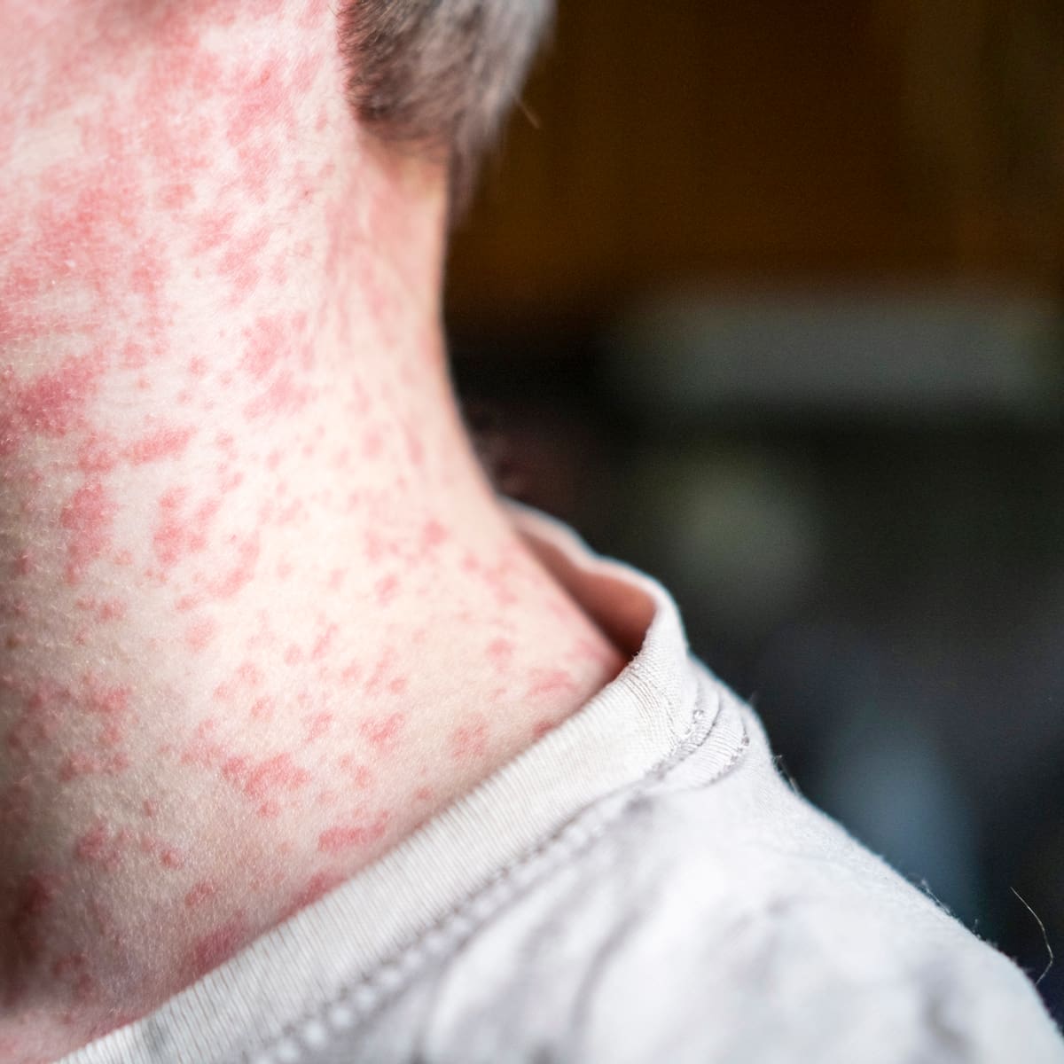 México, Canadá y Estados Unidos registran repunte de casos de sarampión