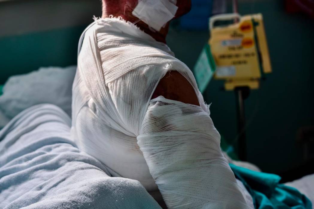 Imagen de referencia de persona quemada con pólvora. / Foto: Archivo - Colprensa.