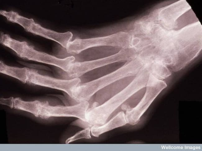 Día Mundial de la Artritis Reumatoide, una enfermedad que no sólo afecta las articulaciones