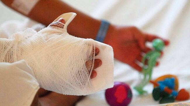Un total de 18 niños y 5 niñas, se vieron afectados en diciembre de 2024 por el uso indebido de pólvpora en el Valle.