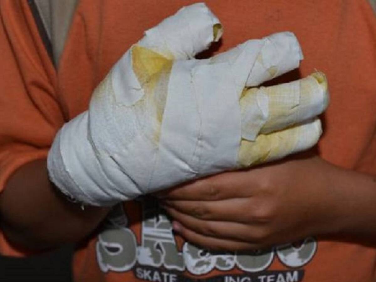 En los primeros 9 días de diciembre, 28 quemados por pólvora en el Valle