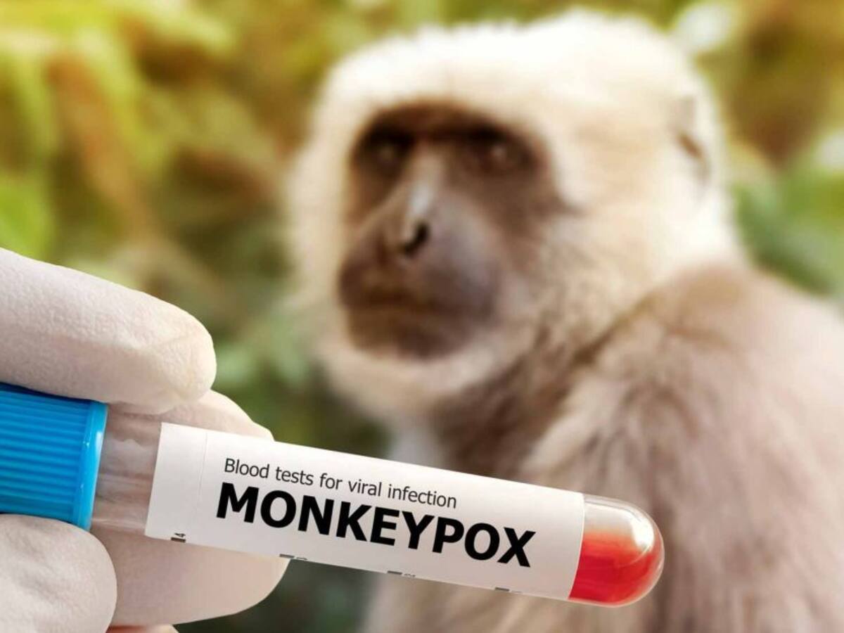 Cuatro casos sospechosos de viruela del mono en Santander