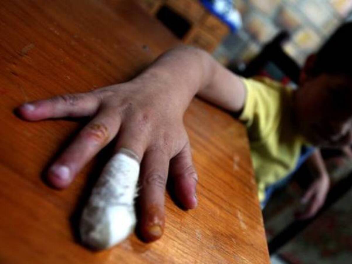 A 346 asciende el número de lesionados con pólvora, 20% menos que en 2016